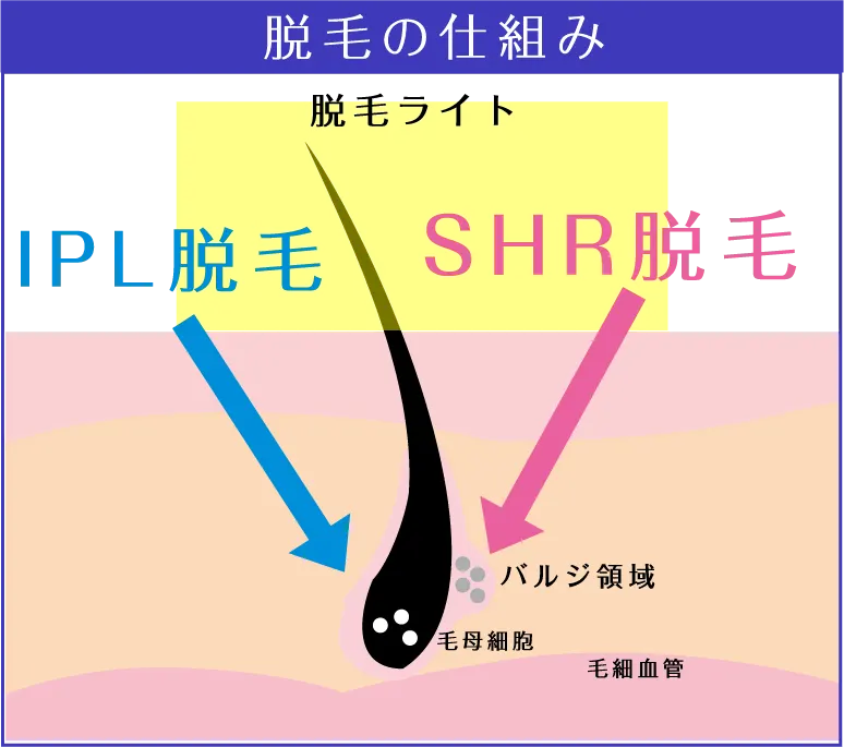 脱毛の仕組み
